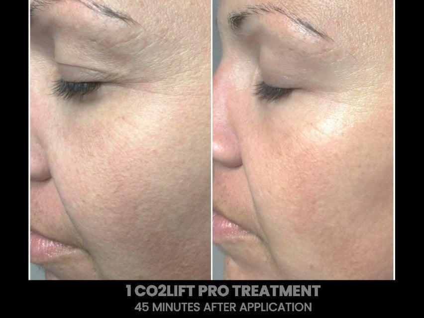 CO2Lift Pro Carboxy Gel Face Mask