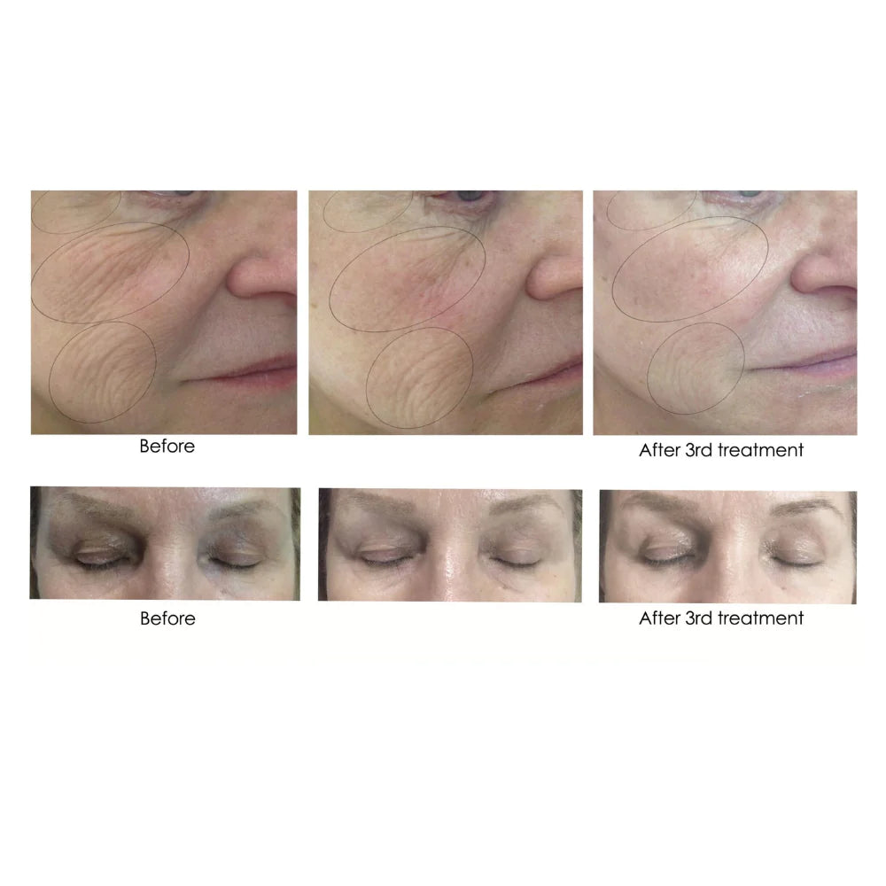 CO2Lift Pro Carboxy Gel Face Mask