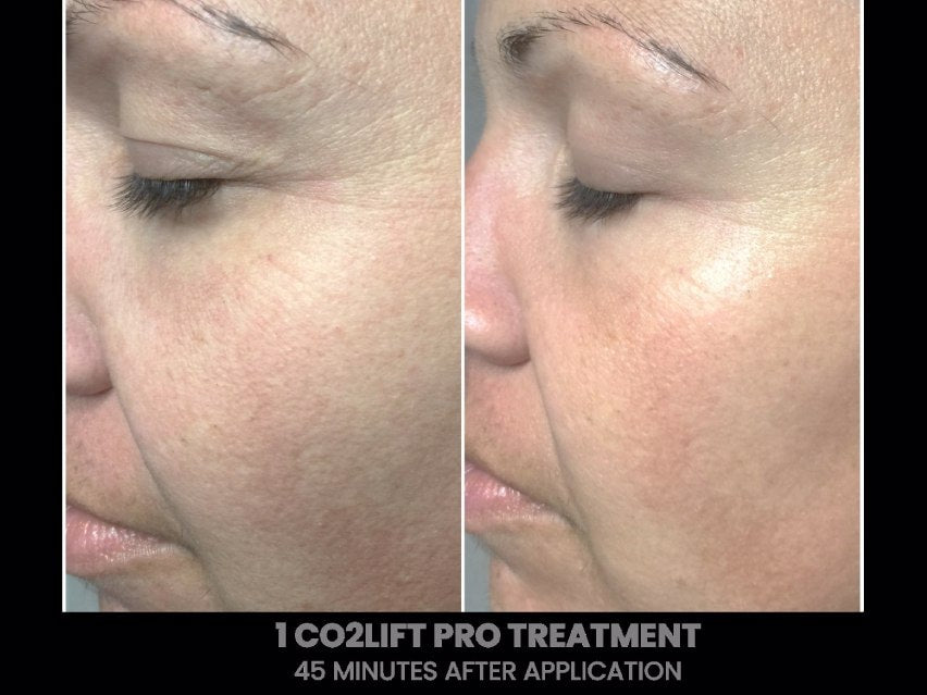 CO2LIFT PRO CARBOXY GEL MASK
