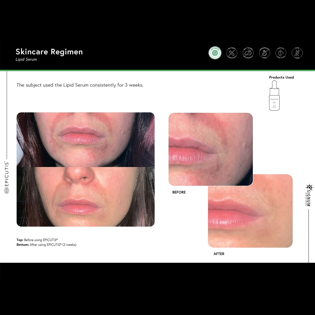 EPICUTIS LIPID SERUM