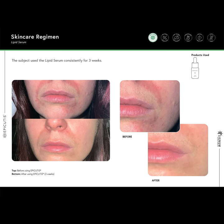 EPICUTIS LIPID SERUM