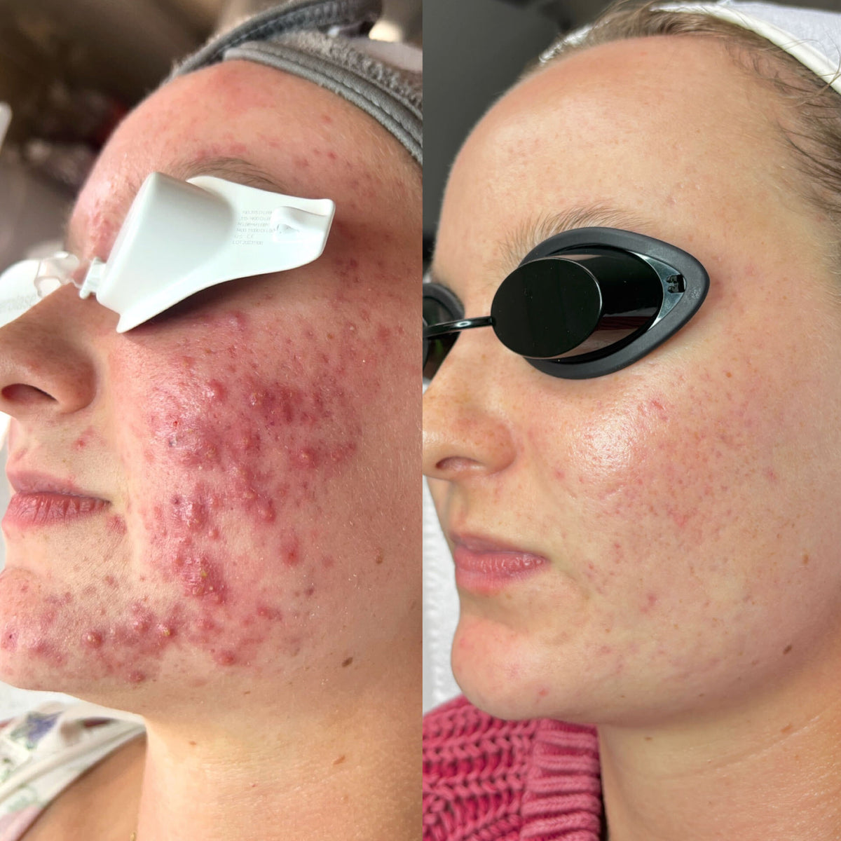 Before / after