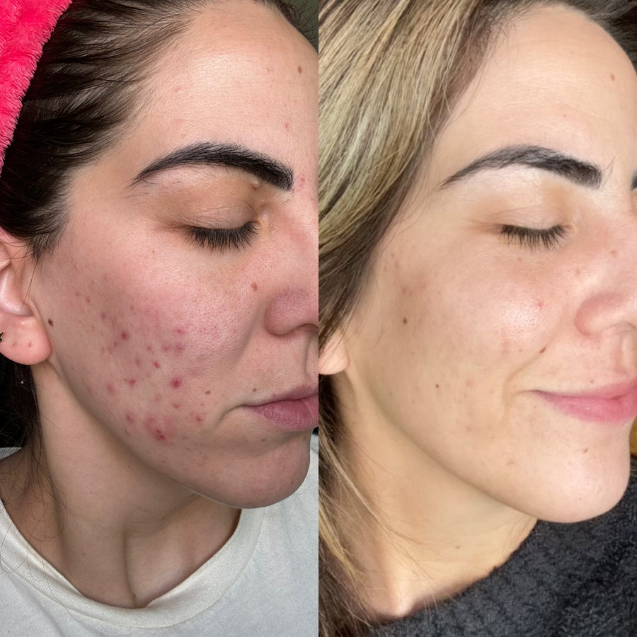 Corrective Facial + Aerolase Neo