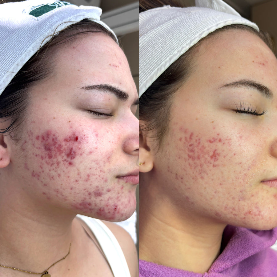 Corrective Facial + Aerolase Neo