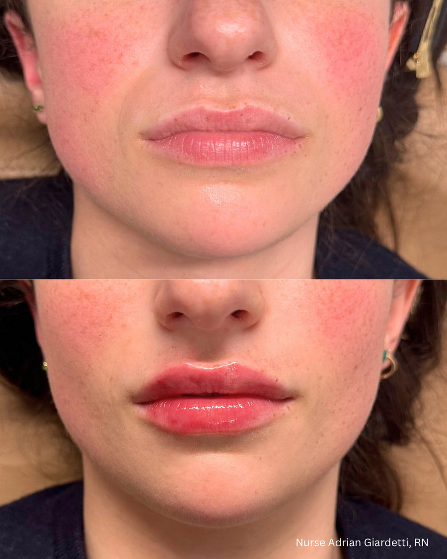 Aerolase Era Elite Laser + Facial Balancing