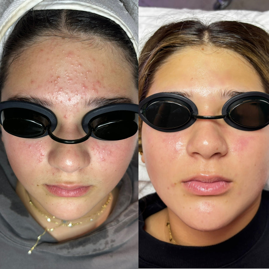 Corrective Facial + Aerolase Neo