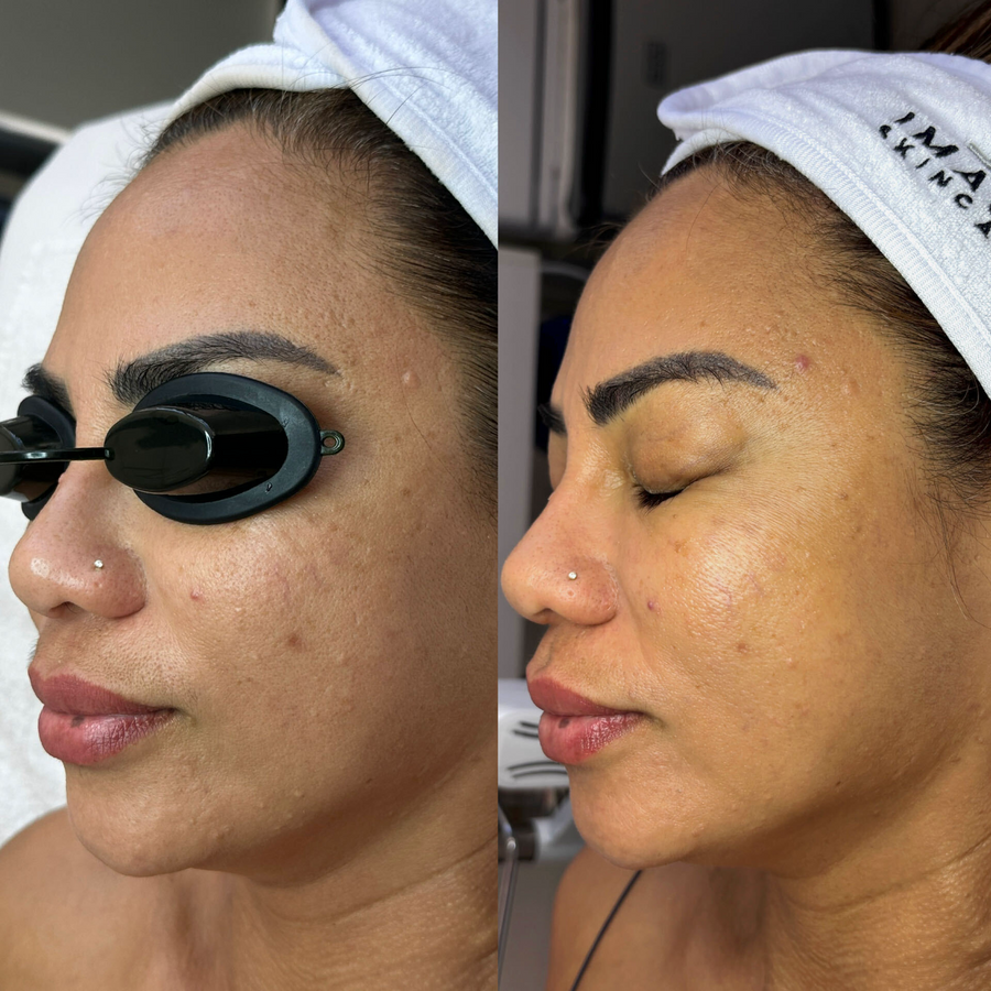  Aerolase Era Elite Laser  + Corrective Facials