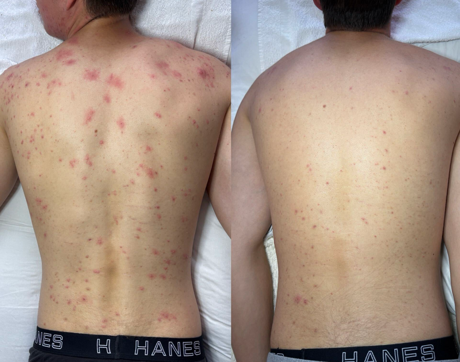  Aerolase Neo Laser Treatment