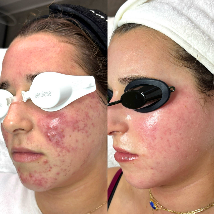 Corrective Facials