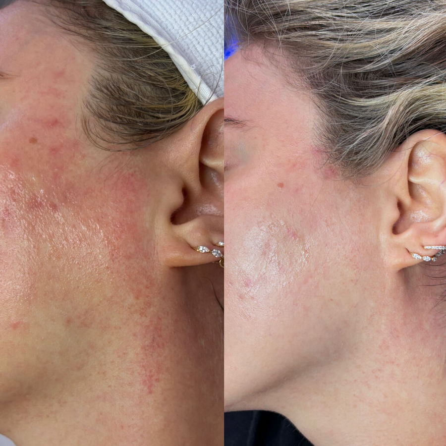 Aerolase Neo Laser Treatment