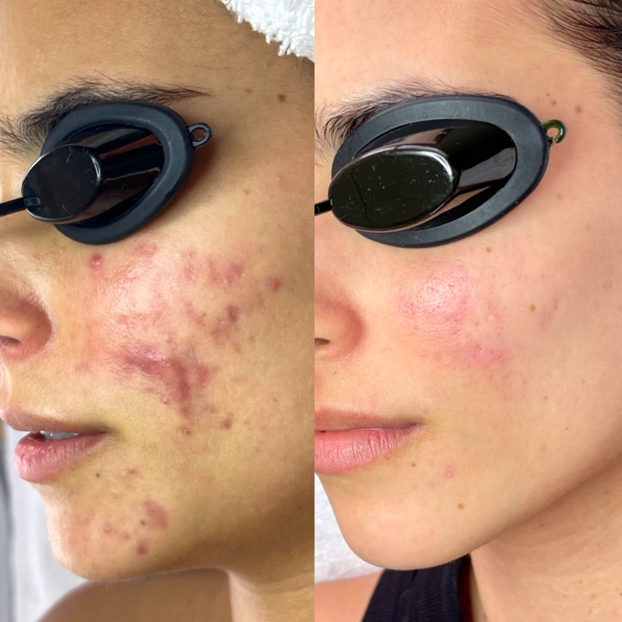 Aerolase Neo Laser Treatment + Aerolase Era Elite Laser + Corrective Facials