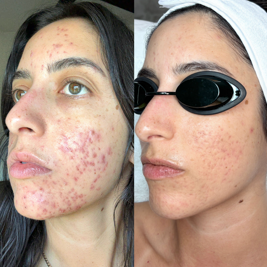   Aerolase Neo Laser Treatments + Corrective Facials