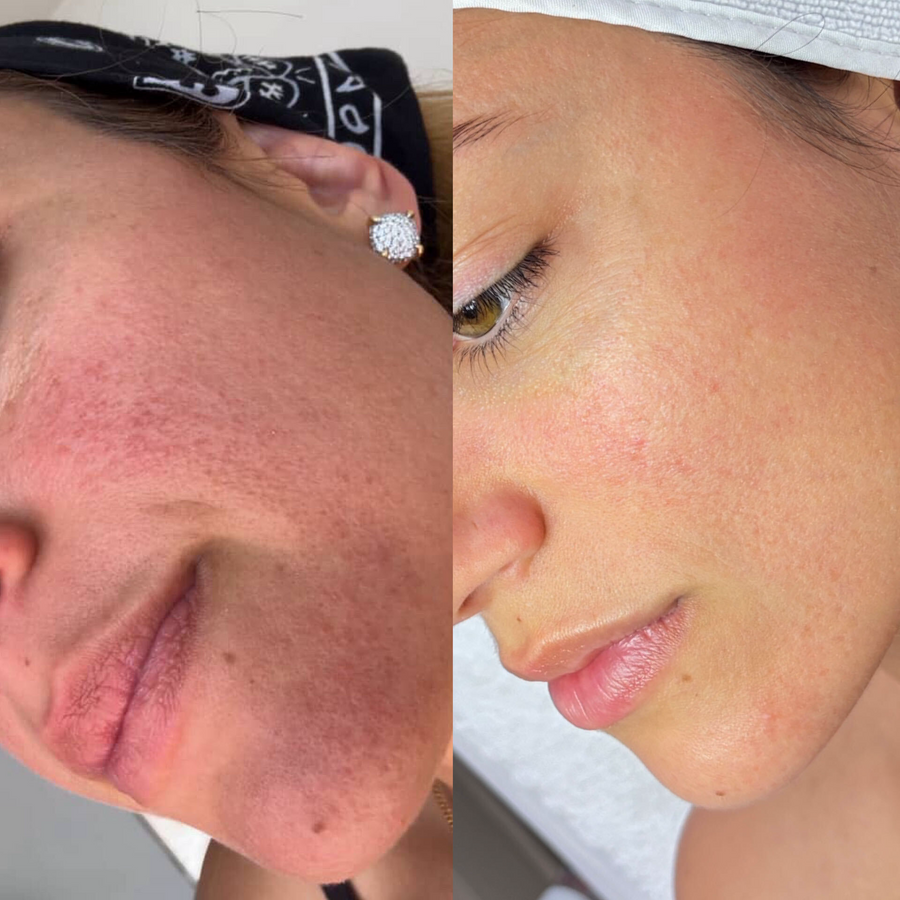  Aerolase Neo Laser Treatment + Aerolase Era Elite Laser + DMK Enzyme Treatments
