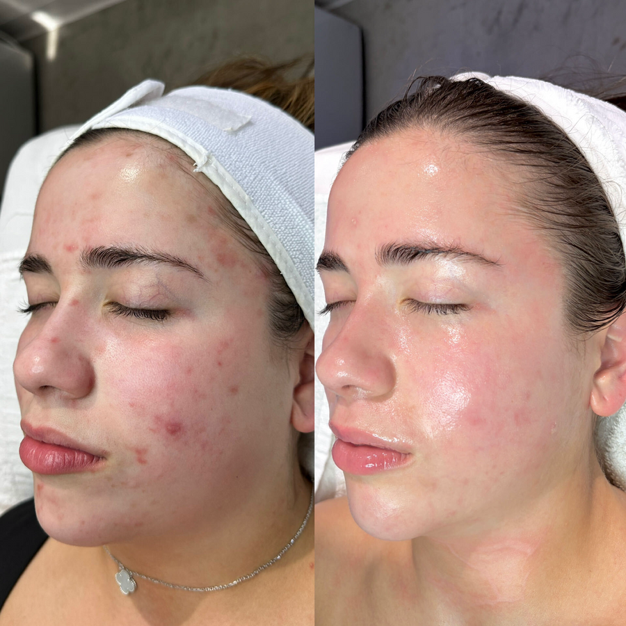 Aerolase Neo Laser Treatment + DMK Enzyme Treatment + Microneedling