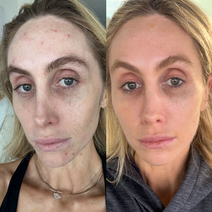 Corrective Facials + Microneedling + Facial Balancing