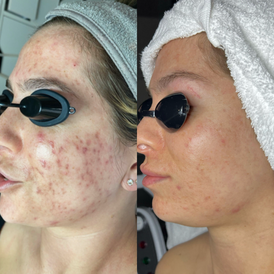 Corrective Facials