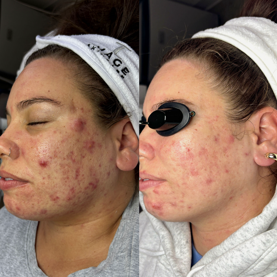   Aerolase Neo Laser Treatment + Corrective Facials  