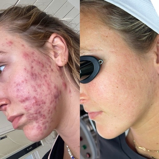 Corrective Facials + Aerolase Neo Laser Treatment + Microneedling