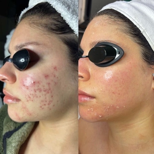   Corrective Facials + Aerolase Neo Laser Treatment + Aerolase Era Elite Laser