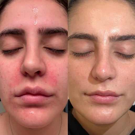 Corrective Facials