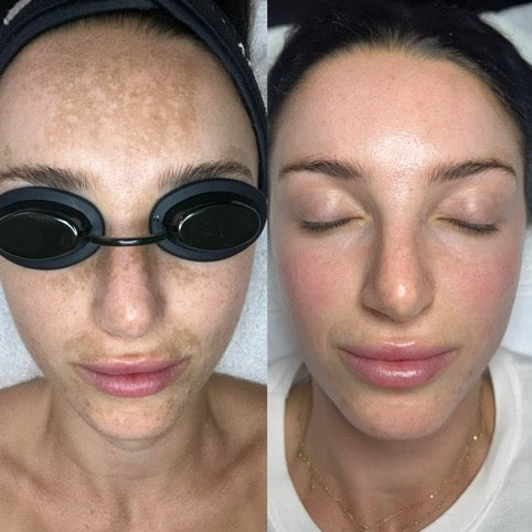 Pigment Peel + Corrective Facials