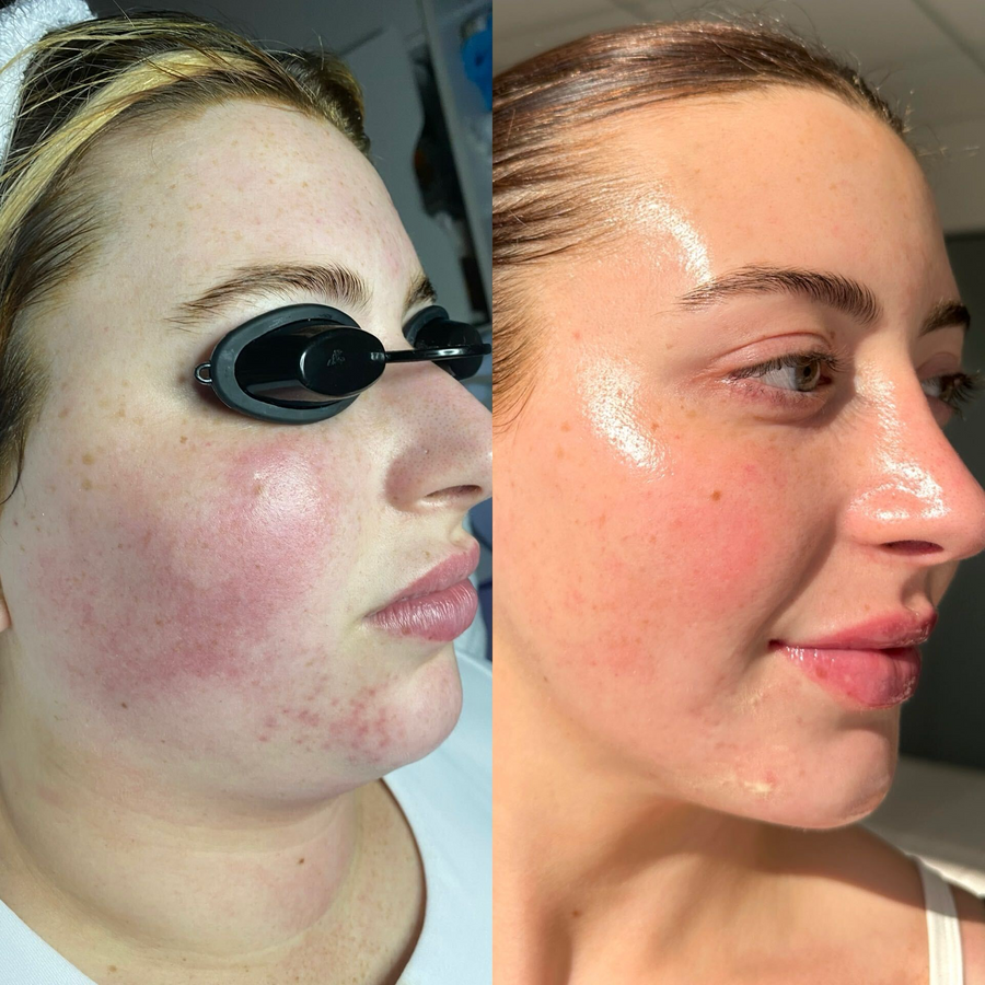 Aerolase Neo + Glow Facials 