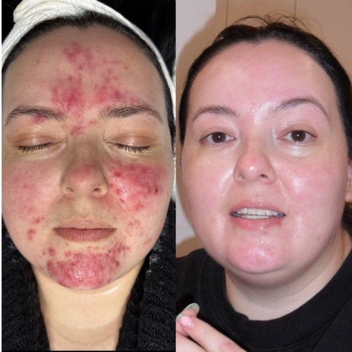 Aerolase Neo Laser Treatment + Aerolase Era Elite + Corrective Facials